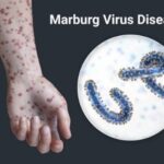 Muxuu yahay Cudurka ka dilaacay Itoobiya ee Walaaca laga Muujiyay?